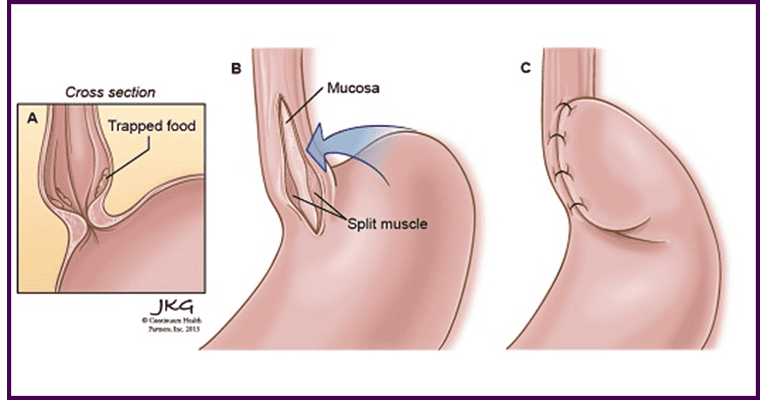 Hernia Surgery
