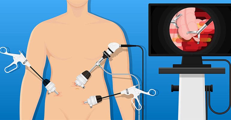 Hernia Surgery