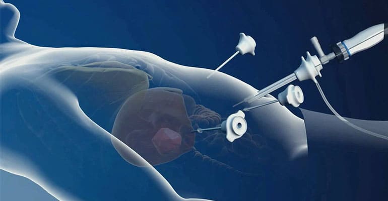 Hernia Surgery