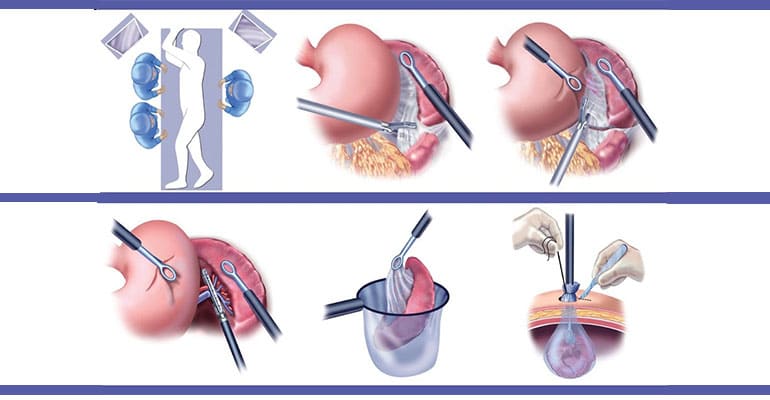 Hernia Surgery
