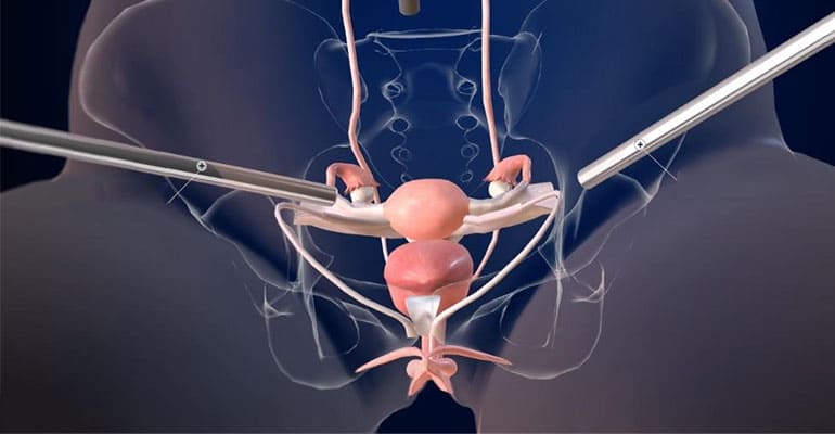 Hernia Surgery