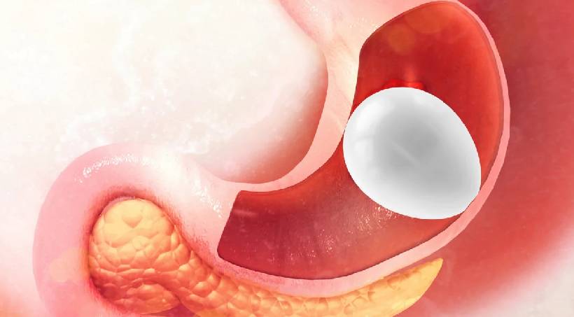 Endoscopic Gastric Balloon