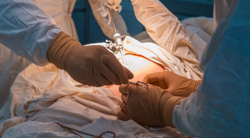 Hiatus Hernia and Antireflux Surgery