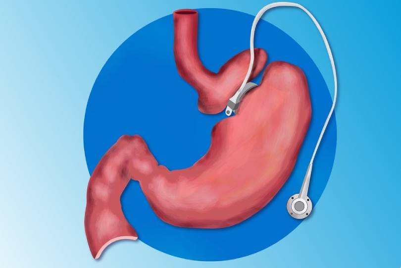 Laparoscopic Gastric Bypass Surgery