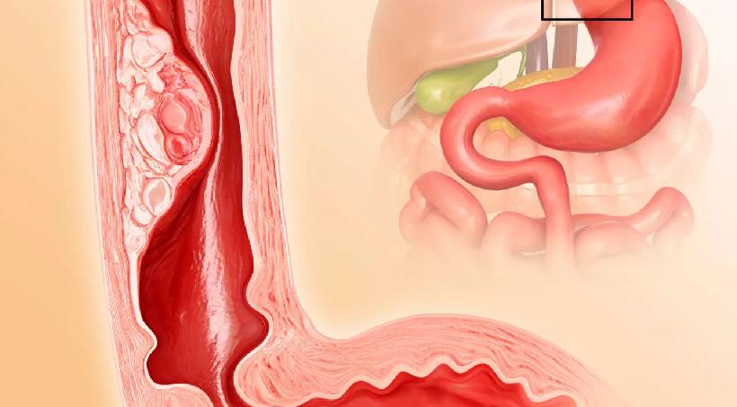 Laparoscopic Gastric Bypass Surgery