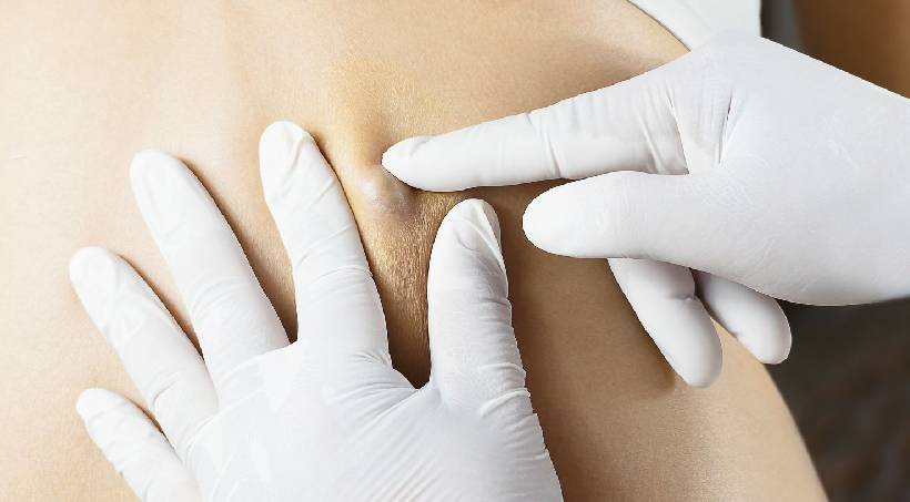 Sebaceous cysts
