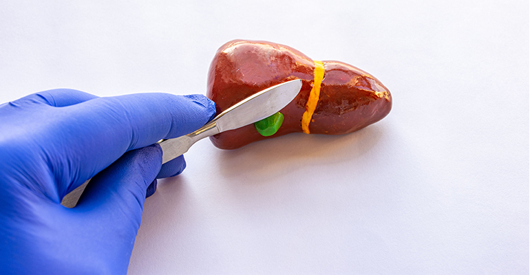 Gall Bladder Surgery
