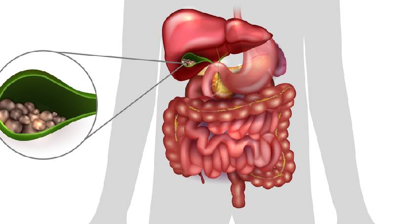 gallstones