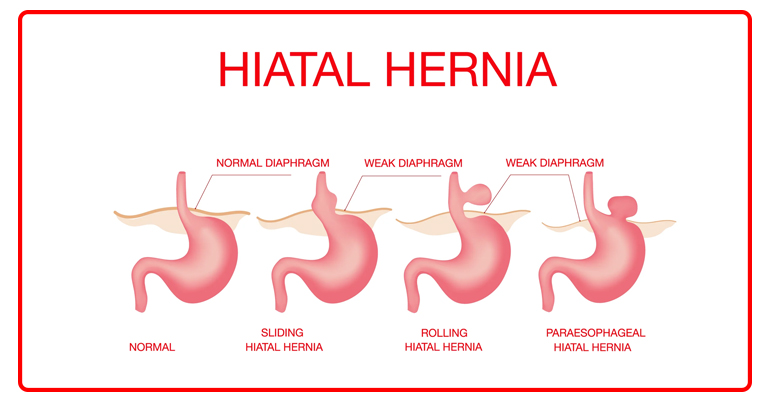 Hernia Surgery